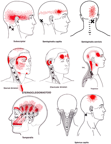 Cervicogenic headaches diagram