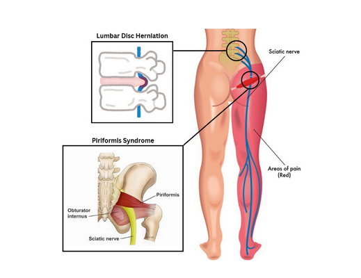 sciatica-pain