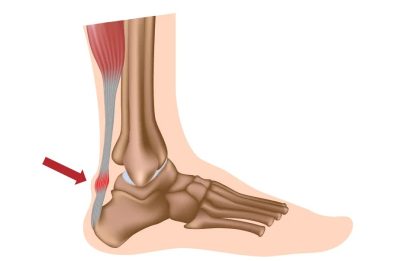 Achilles Tendinopathy-Running Injuries
