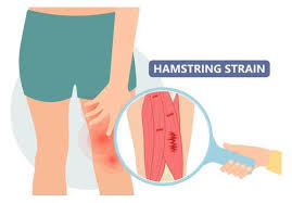 Hamstring Strains-Running Injuries