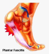 Plantar Fasciitis-Running Injuries