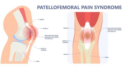 Runners Knee-Running Injuries