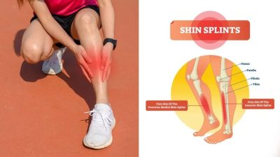 Shin Splints-Running Injuries