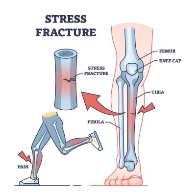 Tibial Stress Fractures-Running Injuries
