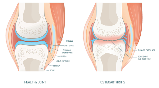 What is Osteoarthritis
